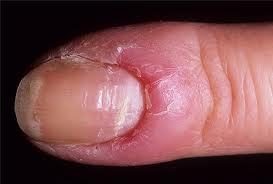 Причины и лечение грибковой инфекции ногтей и кожи