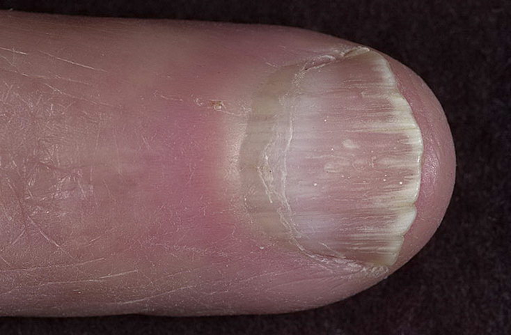 заболевания ногтей