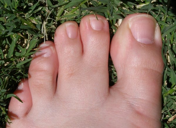 Почему ногти становятся волнистыми у детей и как лечить деформированные ногтевые пластины