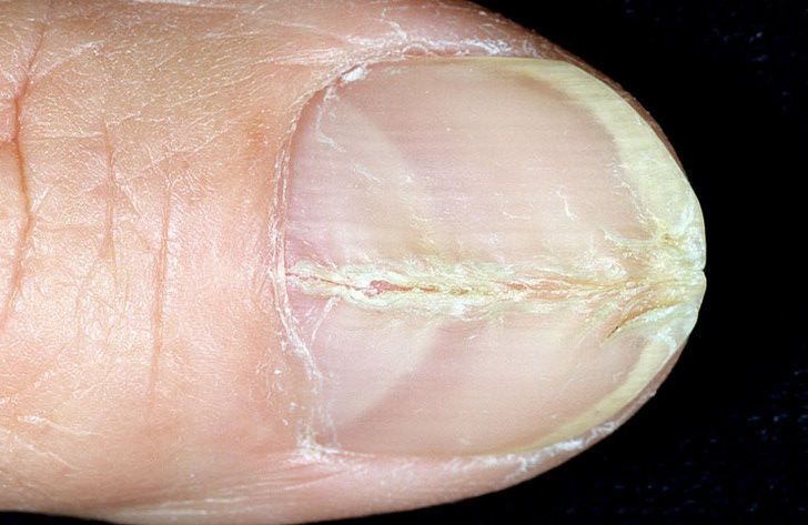 Лечение ребристых ногтей